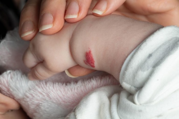 Hemangioma no braço de um bebê - (Foto: Depositphotos)